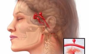 Cюжет в программе "Панорама дня" на телеканале СТВ, посвященный удалению гигантской аневризмы в сосудистом отделении Национального центра нейрохирургии