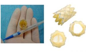 Уникальная операция без хирургического вмешательства