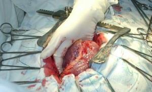 Қосымша  бір өмір немесе  жаңа  жүрек!