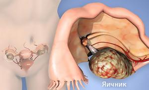 Рак яичников :Новый взгляд на старую проблему