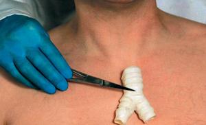 Впервые внедрен орган, сделанный в лаборатории